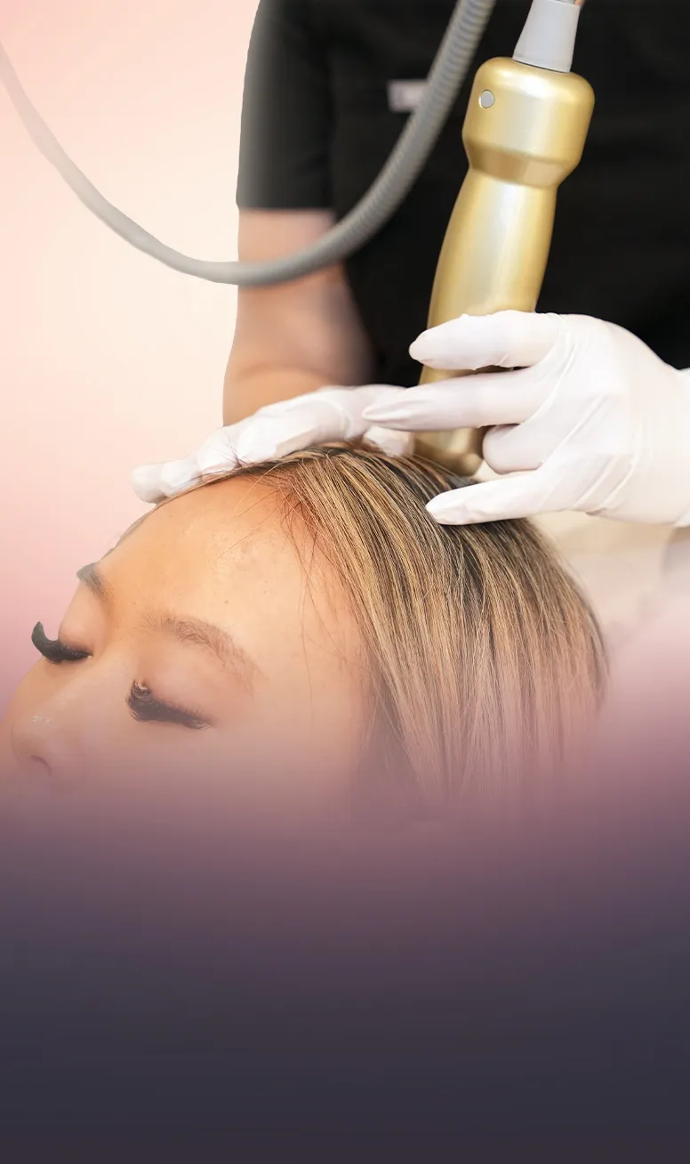Sylfirm X RF Microneedling (Scalp) treatment at Toronto medical spa